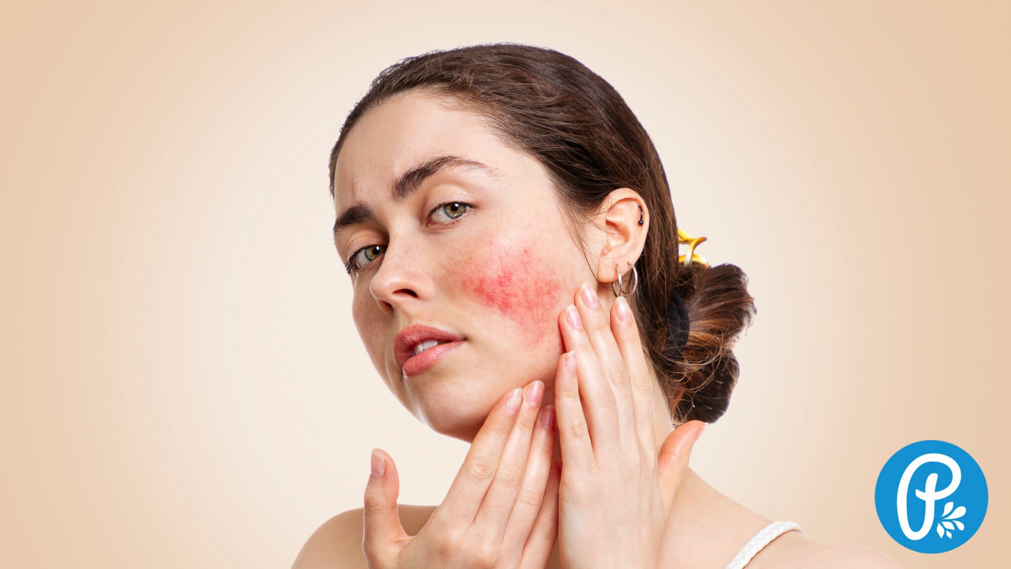 Růžovka rosacea jemná péče Panakeia
